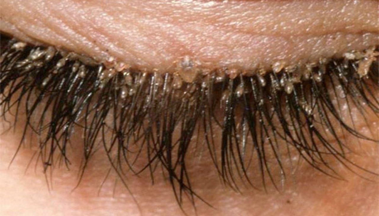 Imagen Principal de Nota: Advierten a hondureñas  sobre riesgo de presentar piojos en extensiones de pestañas