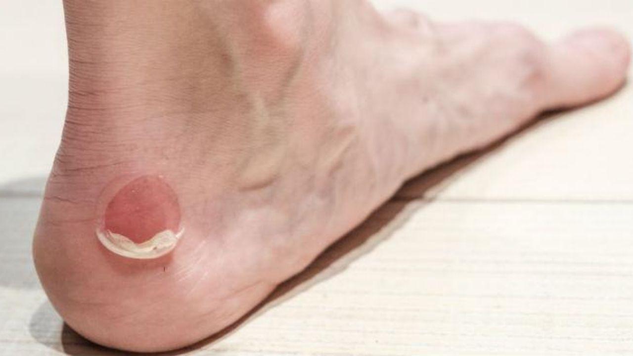Imagen Principal de Nota: 6 remedios caseros que ayudan a curar las ampollas en los pies
