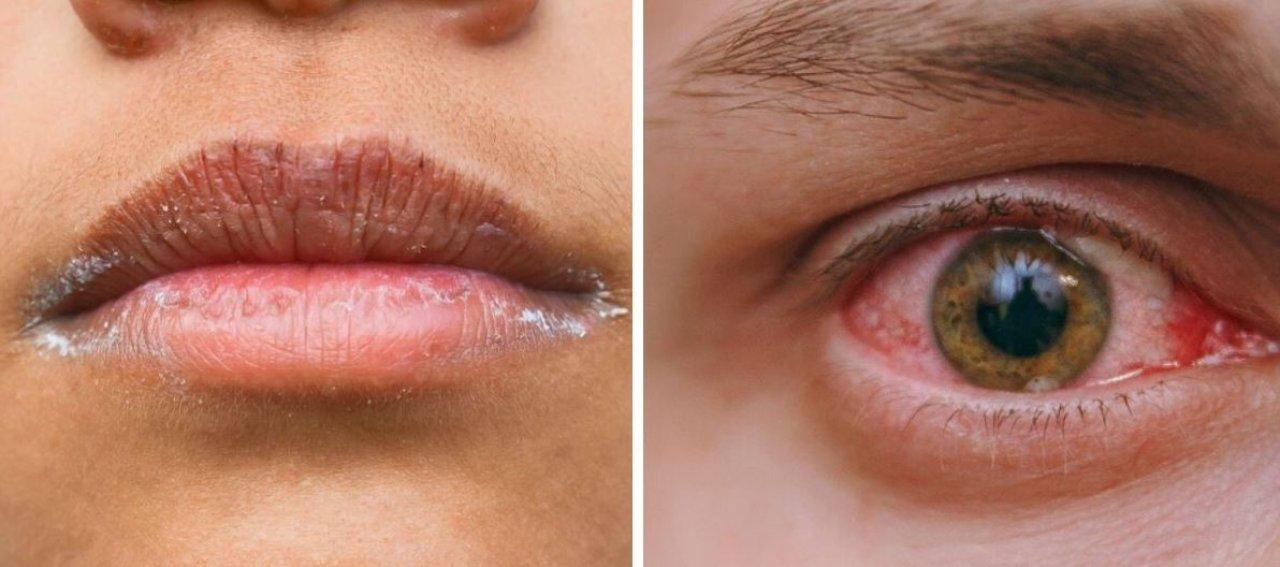 Imagen Principal de Nota: ¿Qué es el síndrome de Sjögren que ataca a las glándulas de la boca y ojos? Aquí sus síntomas