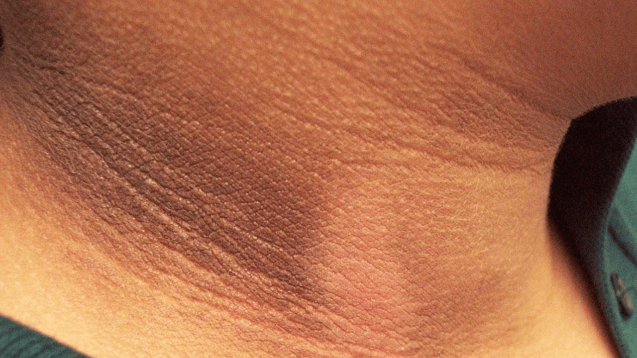 Imagen de ¿Por qué salen las manchas oscuras en el cuello?