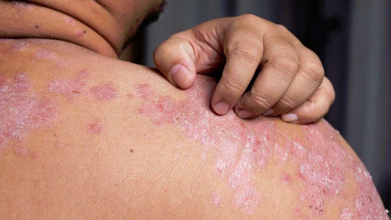 Imagen de Estos son los síntomas de la psoriasis, enfermedad que daña la piel de las personas
