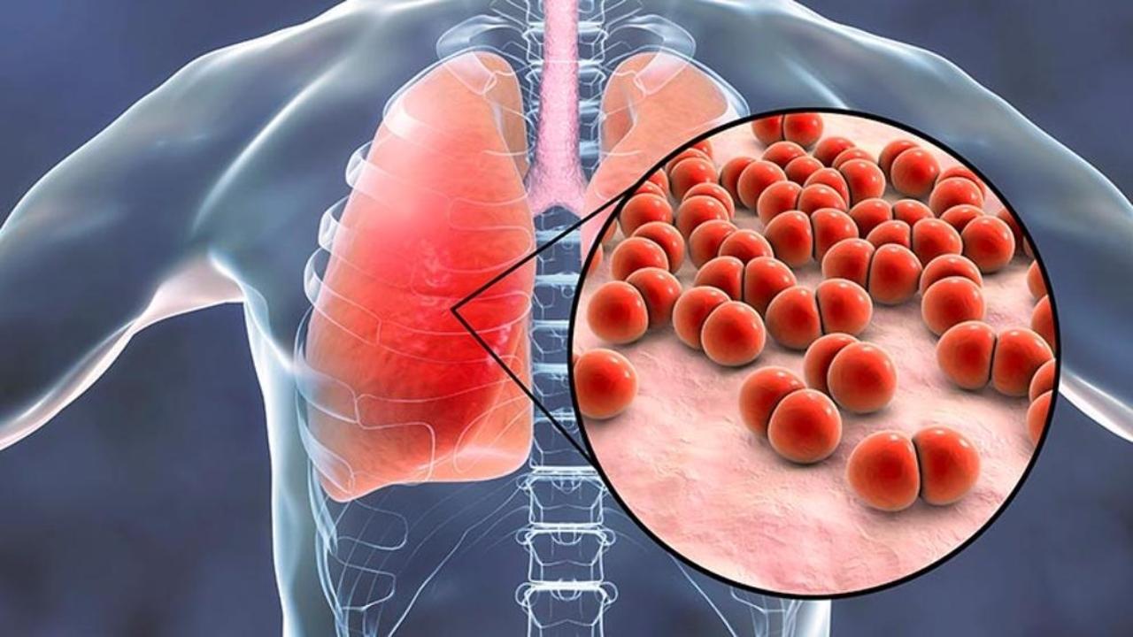 Imagen Principal de Nota: Dolor en el pecho y tos con flemas, ¿cómo saber si tienes neumonía y no covid?