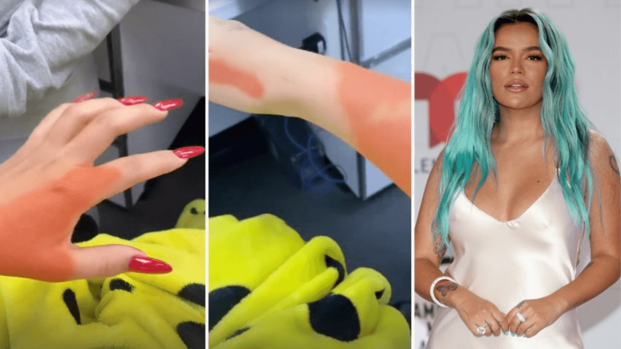 Imagen de ¿En venganza? Karol G también borra sus tatuajes de Anuel AA y así muestra el proceso
