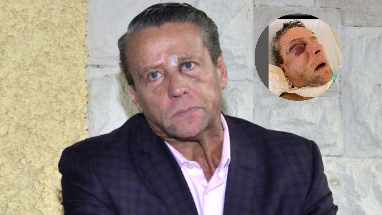 Imagen Principal de Nota: Alfredo Aldame comparte impactantes imágenes tras ser golpeado brutalmente por vecino