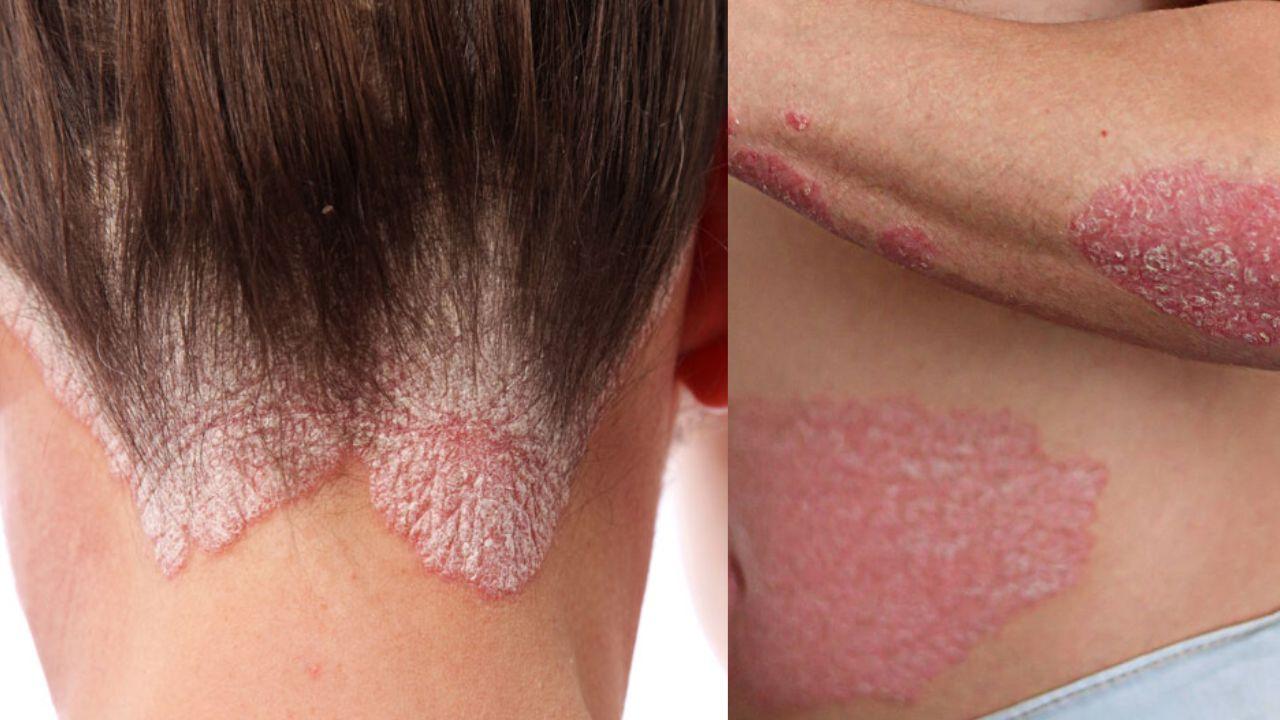 Imagen de ¿Qué es la psoriasis y cómo se trata?