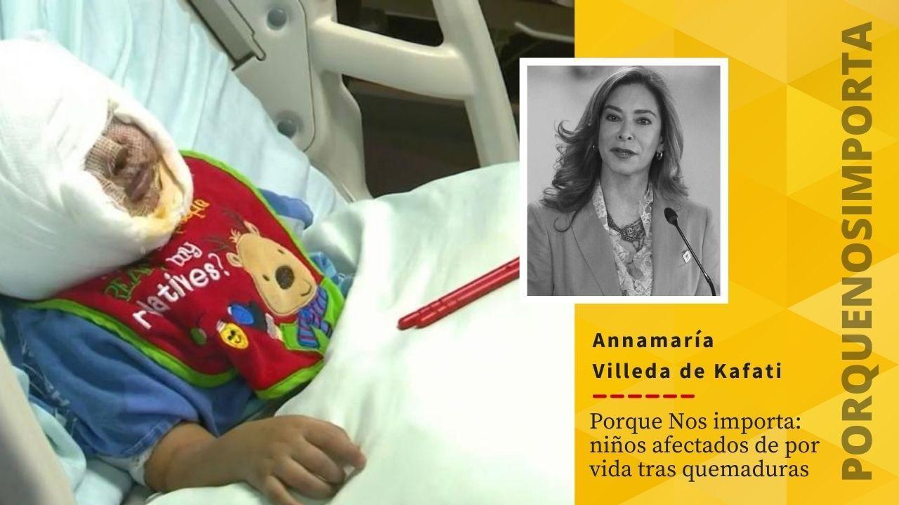 Imagen de Porque Nos importa: niños afectados de por vida tras quemaduras